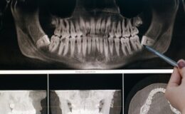 Bölcsességfog húzás és MyDentnél