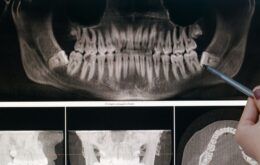 Bölcsességfog húzás és MyDentnél